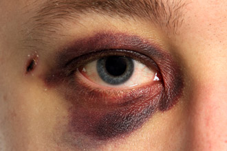 black-eye-330x220
